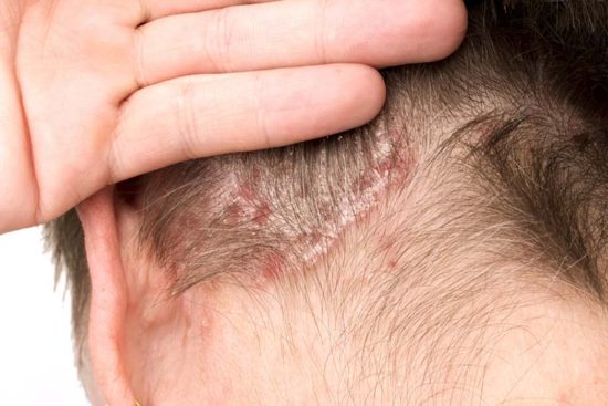 Patienten für Studie zur Kopfhaut-Psoriasis gesucht