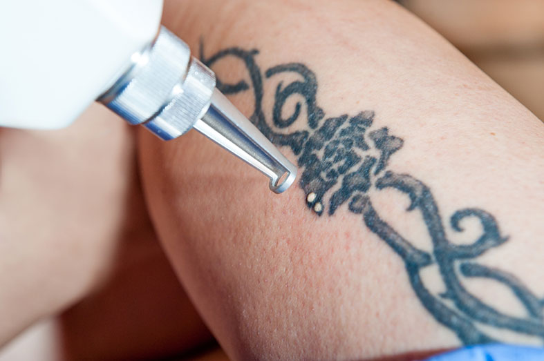 Tattoos und Pigmentstörungen schmerzarm und narbenfrei entfernen