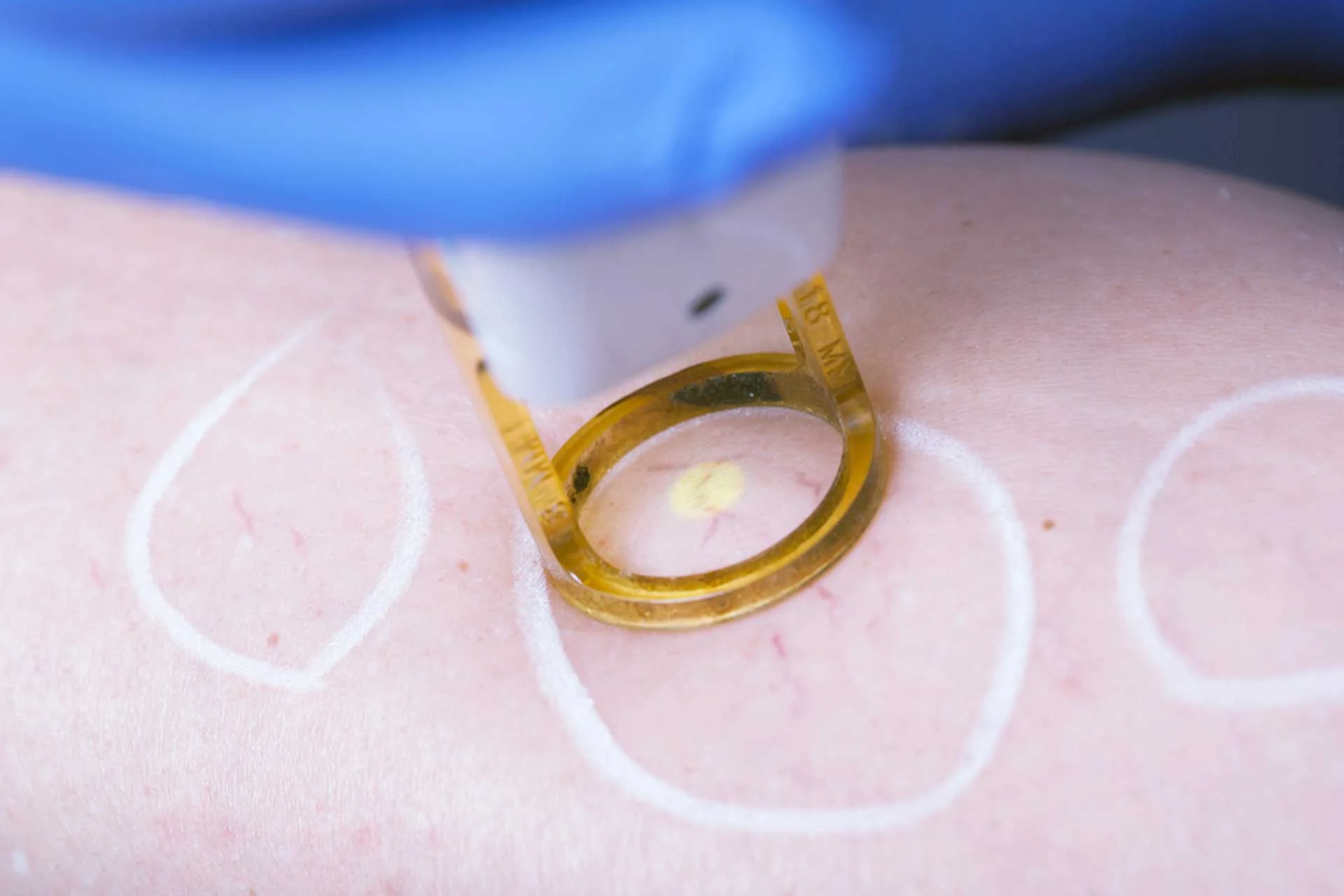 Modernes Lasergerät in einer dermatologischen Praxis, bereit für Hautbehandlungen.